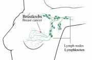 Lymphe aktivieren nach Brustkrebs OP